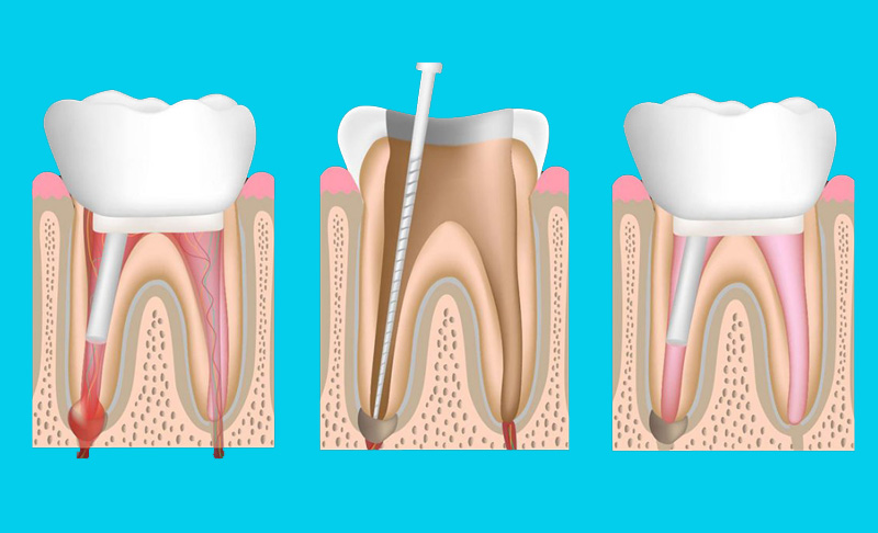 Dental-Filling