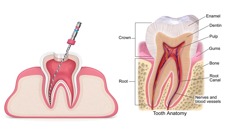 Dental-Filling